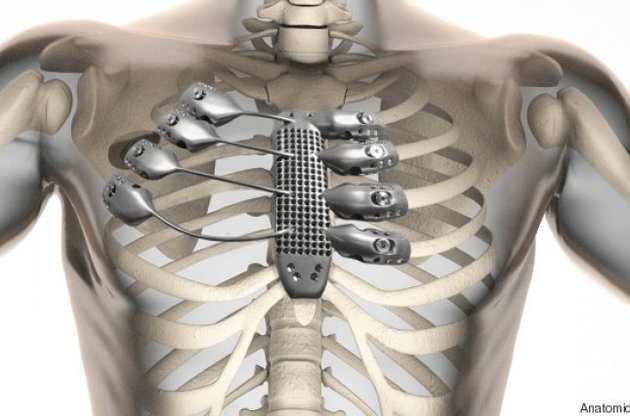 Чоловікові імплантували роздруковану на 3D-принтері грудну клітку