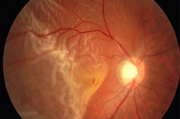 Ученые намерены восстанавливать зрение людям с помощью выращенной из стволовых клеток сетчатки