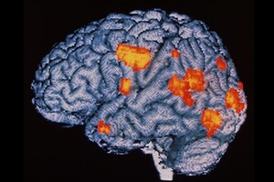 Ученые рассказали об аномалиях мозга у переболевших COVID-19