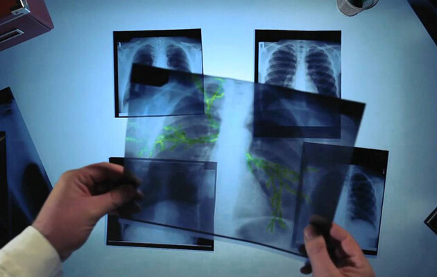 В Украине почти 20 тысяч новых больных туберкулезом - Минздрав