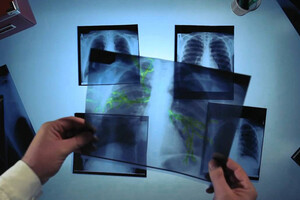 В Україні майже 20 тисяч нових хворих на туберкульоз – МОЗ