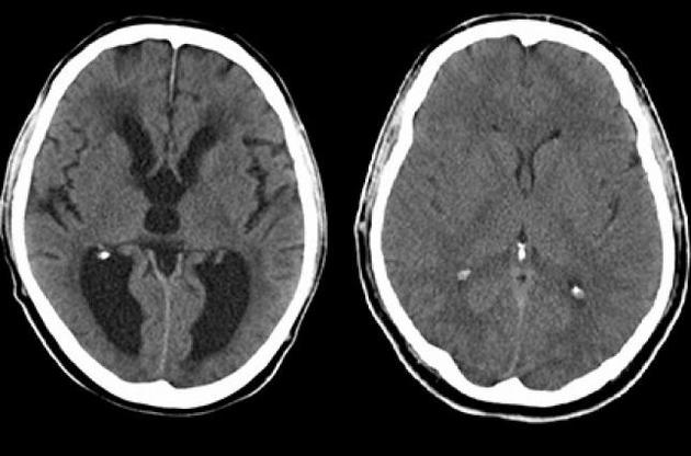 Встановлена причина розвитку гідроцефалії