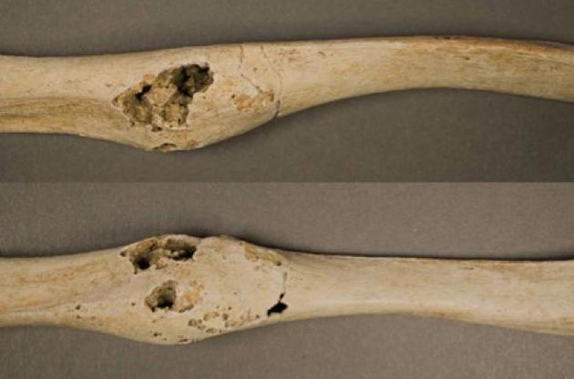 Подросток скончался от рака кости