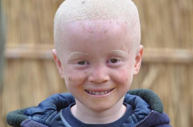 В ООН хотят развеять мифы об альбиносах