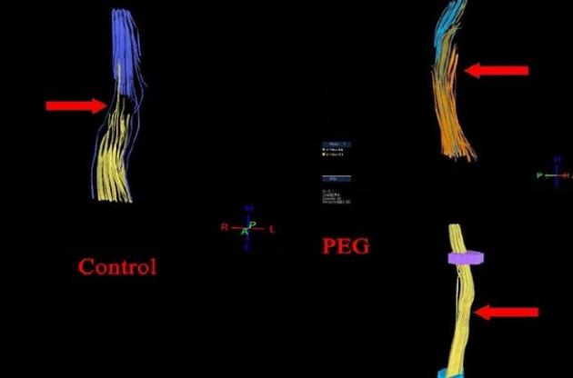 Ученые восстановили разрезанный спинной мозг