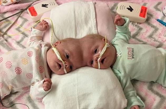 Хирурги из США успешно разделили сиамских близнецов с общей головой