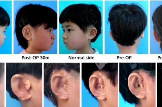 Китайские ученые вырастили детям ушные раковины на основе их собственных клеток