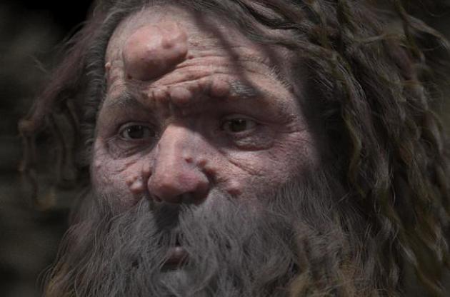 Обличчя чоловіка було вкрите доброякісними пухлинами