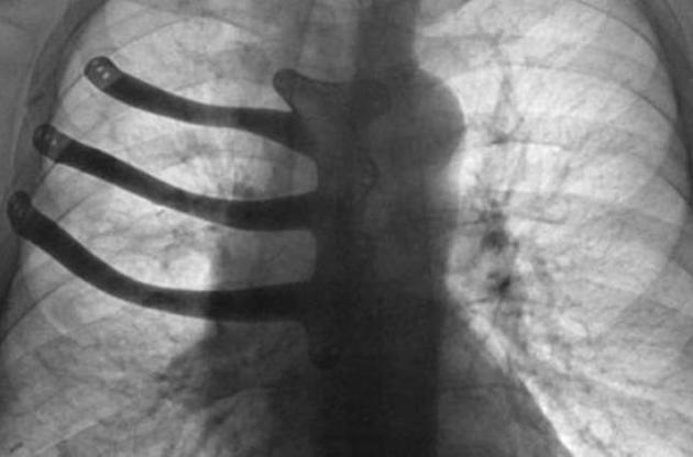 Одеська та Житомирська області лідирують за рівнем захворюваності на туберкульоз