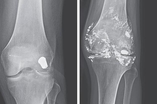 Куля розпалася на частини і викликала отруєння свинцем