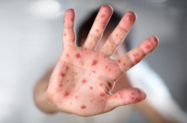 Минздрав анонсировал спецкампанию по вакцинации детей против кори в Львовской области