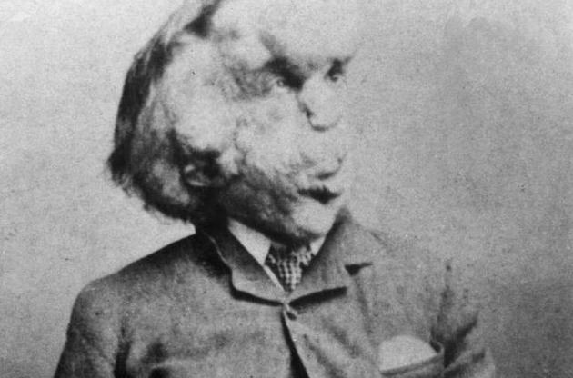 У Лондоні знайдена могила з м&#039;якими тканинами Джозефа Мерріка