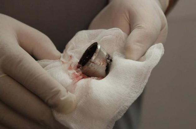 Із тіла дитини дістали осколок