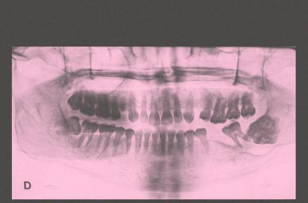 Из нижней челюсти семилетнего мальчика удалили опухоль с 526 "зубами"