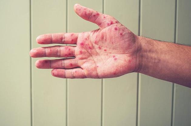 У 2018 році Україна стала світовим лідером за захворюваністю на кір