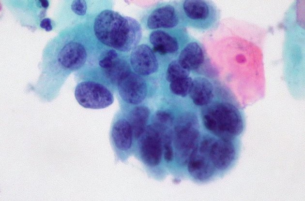 Ученые смогут определить 13 видов рака по одной капле крови