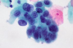 Вчені зможуть визначити 13 видів раку по одній краплі крові