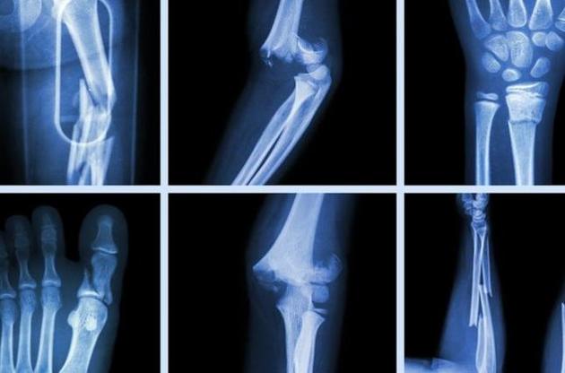 Датський стартап розробив технологію друку індивідуальних протезів кісток
