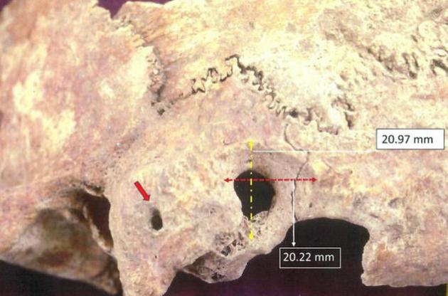 Археологи обнаружили останки людей IV - VII веков с необычными хирургическими вмешательствами