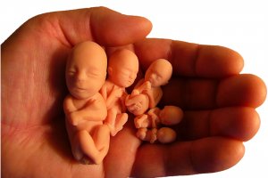 20 лет абортам в подполье