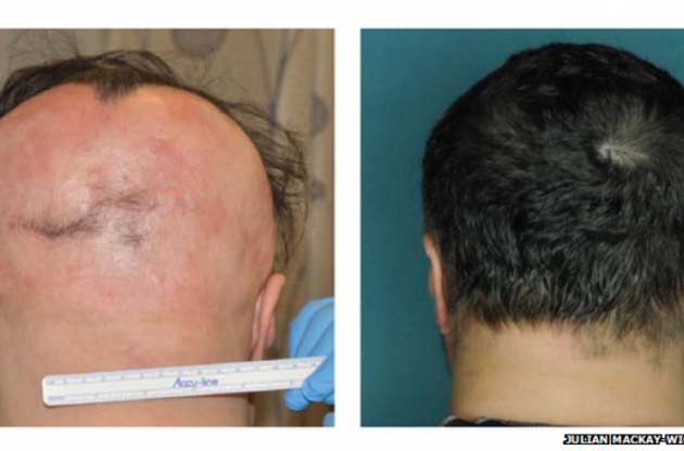 Ученые обнаружили средство, реально спасающее от облысения