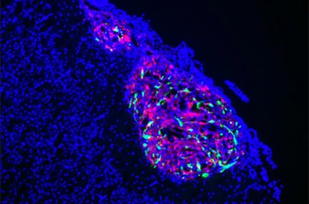 Вчені почали лікувати рак за допомогою генної терапії