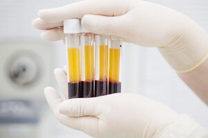 Лікування COVID-19 плазмою крові перехворілих є експериментальним – ВООЗ 