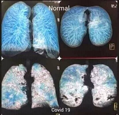 Тернопільські лікарі показали, як виглядають легені хворого на коронавірус 