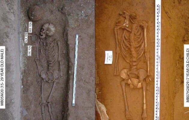 Сліди тропічного сифілісу знайшли у дитини і молодої людини