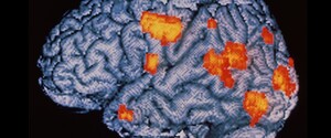 Вчені знайшли нову рідкісну форму деменції 
