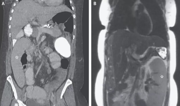 Селезінка жінки змістилася на 30 сантиметрів