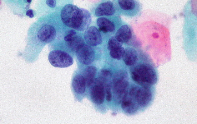 Вчені розповіли про «ахіллесову п'яту» ракових клітин 