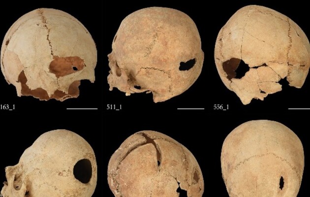 У середньовічній Франції неврологічні розлади лікували трепанацією черепа 