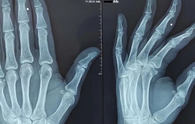 Вчені описали схоже на артрит захворювання