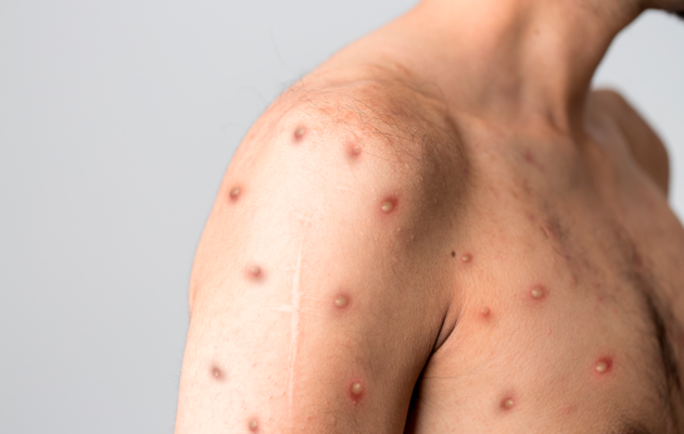 У світі зареєстрували понад 18 тисяч випадків зараження віспою мавп