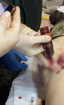 Медики изъяли из тела раненого военного гранату, которая не разорвалась