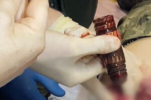 Медики изъяли из тела раненого военного гранату, которая не разорвалась