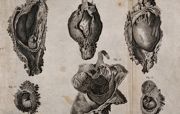 Шесть схем абортов на разных терминах. Гравюра Кэмпбелла