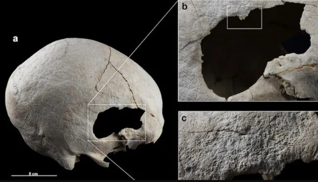 Жінці зробили дві операції на черепі 4500 років тому