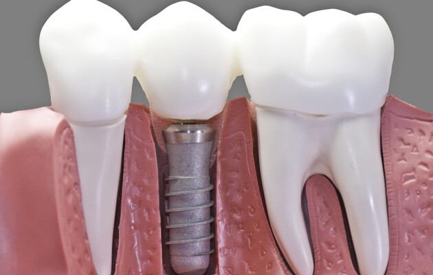 Зубні імпланти: переваги та їх вартість