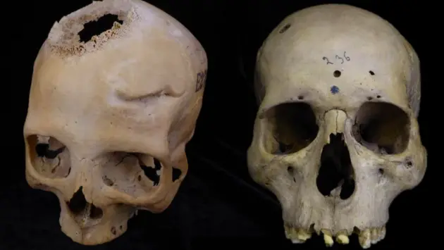 В черепе из Древнего Египта обнаружили следы сложной хирургической операции