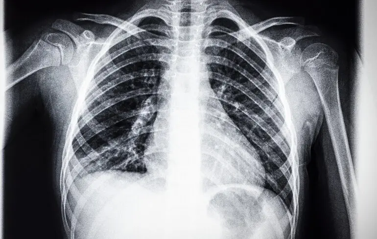 Штучний інтелект може допомагати медикам читати рентген грудної клітини