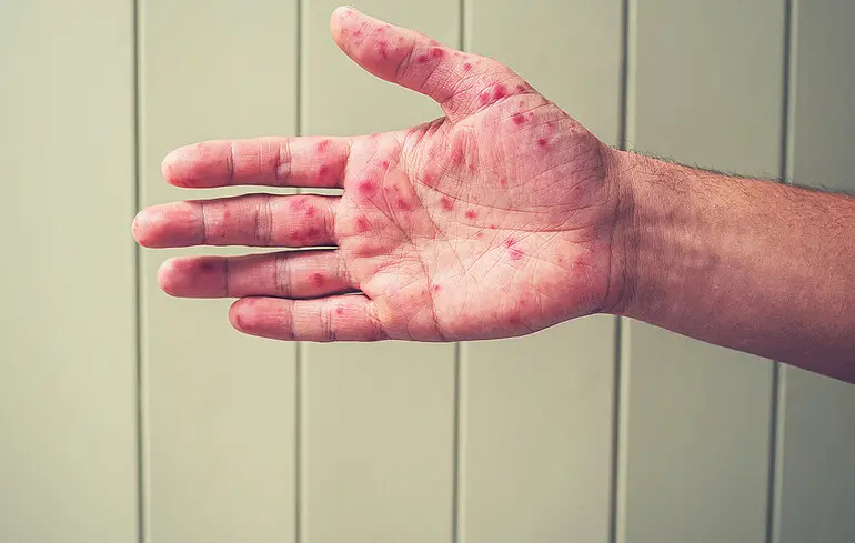 Підозра на кір: як розпізнати хворобу