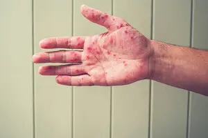 Подозрение на корь: как распознать болезнь