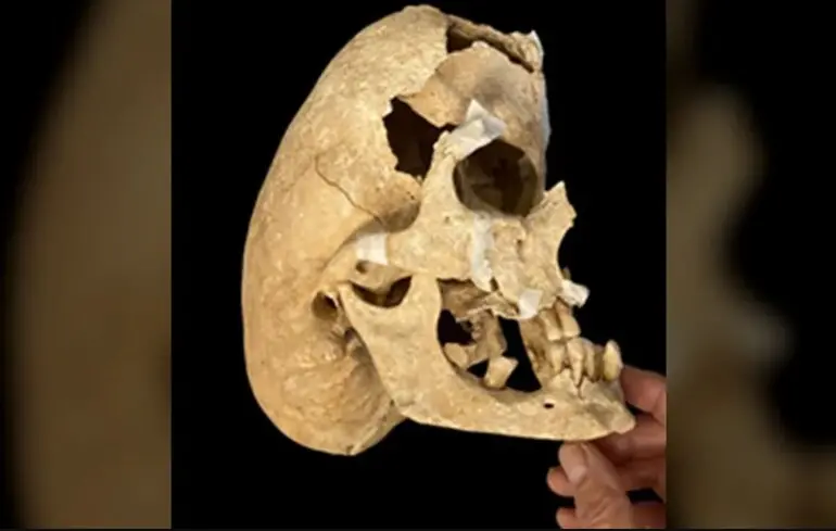 З рідкісним генетичним захворюванням: учені знайшли незвичайний скелет середньовічного лицаря