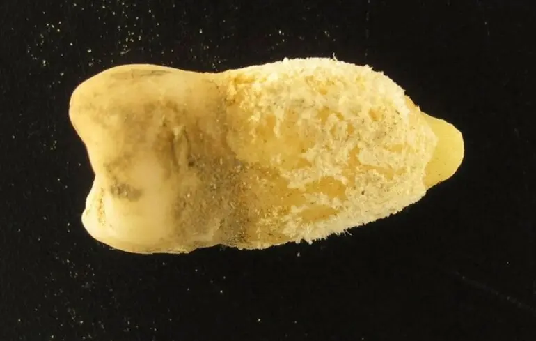 Переписывает историю скарлатины: ученые изучили зуб мумии из Боливии