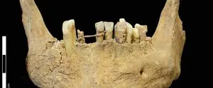Археологи нашли золотой зубной мост возрастом 500 лет