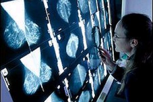 Ученые обнаружили мутации генов, которые приводят к раку груди