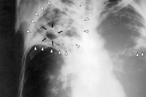 Британські вчені знайшли спосіб швидко виявити туберкульоз