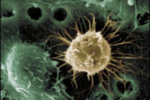 Ученые экспериментально имплантировали стволовые клетки в мозг пациента после инсульта